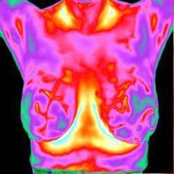 Breast thermography results from thermography clinic at True Potential