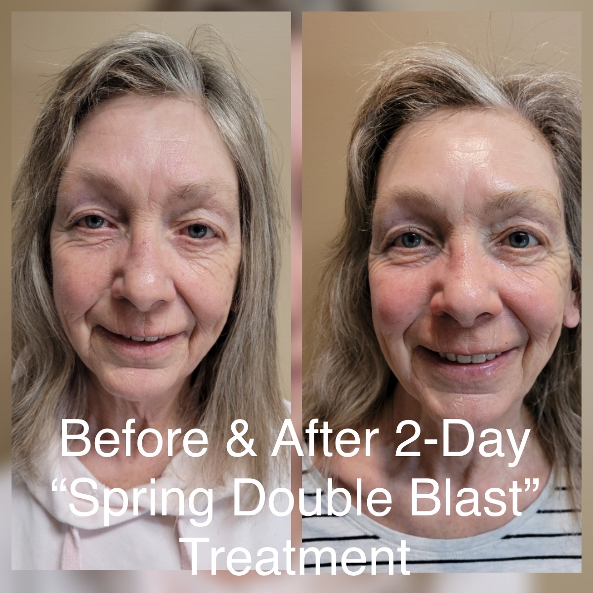 Before and after Spring Skincare Special 2-Day Treatment