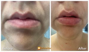 Before and after picture of at-home 6 minute lip plumping treatment with LED lip device and hyaluronic acid serum